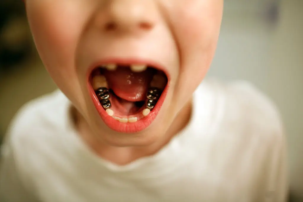 Baby Teeth Don’t Need Much Care Because They’ll Fall Out Anyway